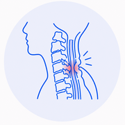 Estenosis Espinal Cervical