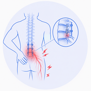 Failed Back Surgery Syndrome