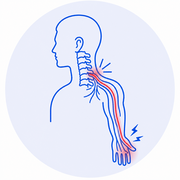 Pinched Nerve