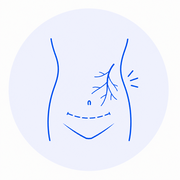 Post-Abdominal Surgery Pain
