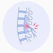 Post-Laminectomy Syndrome