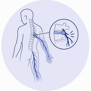 Radiculopathy