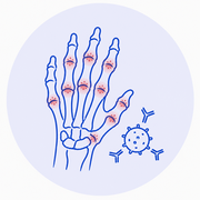 Rheumatoid Arthritis